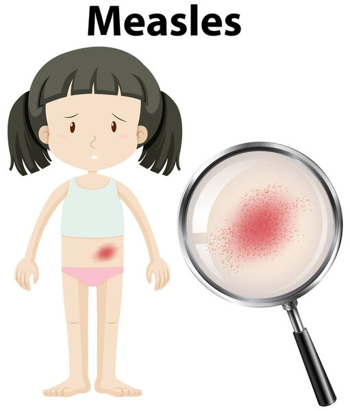 A Girl Having Measles illustration
