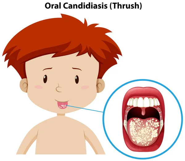 Menino Jovem Com Candidíase Oral Ilustração —  Vetores de Stock