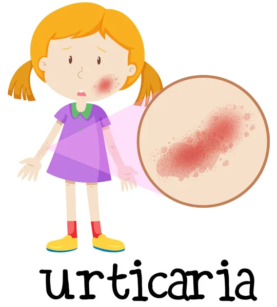 Een Meisje Met Urticaria Huid Illustratie — Stockvector