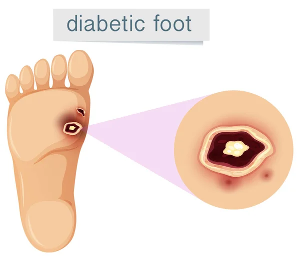 Piede Diabetico Sfondo Bianco Illustrazione — Vettoriale Stock