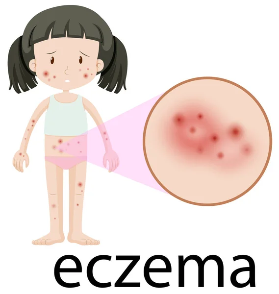 白背景イラストに湿疹を持つ少女 — ストックベクタ