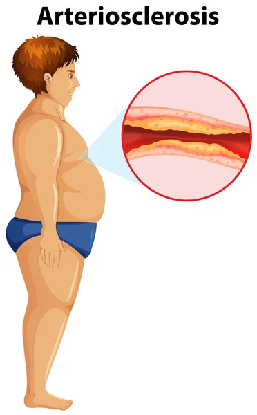 Hombre Con Sobrepeso Con Arteriosclerosis Ilustración — Vector de stock