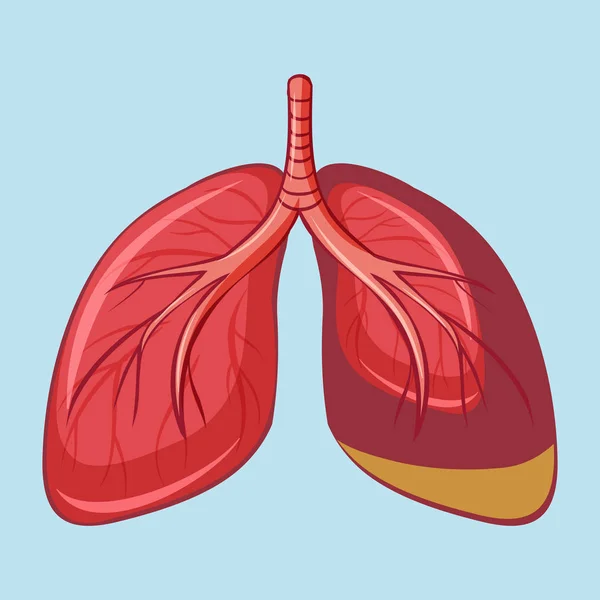 Poumon Humain Avec Illustration Mésothéliome Pleural — Image vectorielle