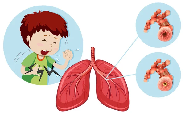 Bir Adam Olan Kronik Obstrüktif Akciğer Hastalığı Illüstrasyon — Stok Vektör