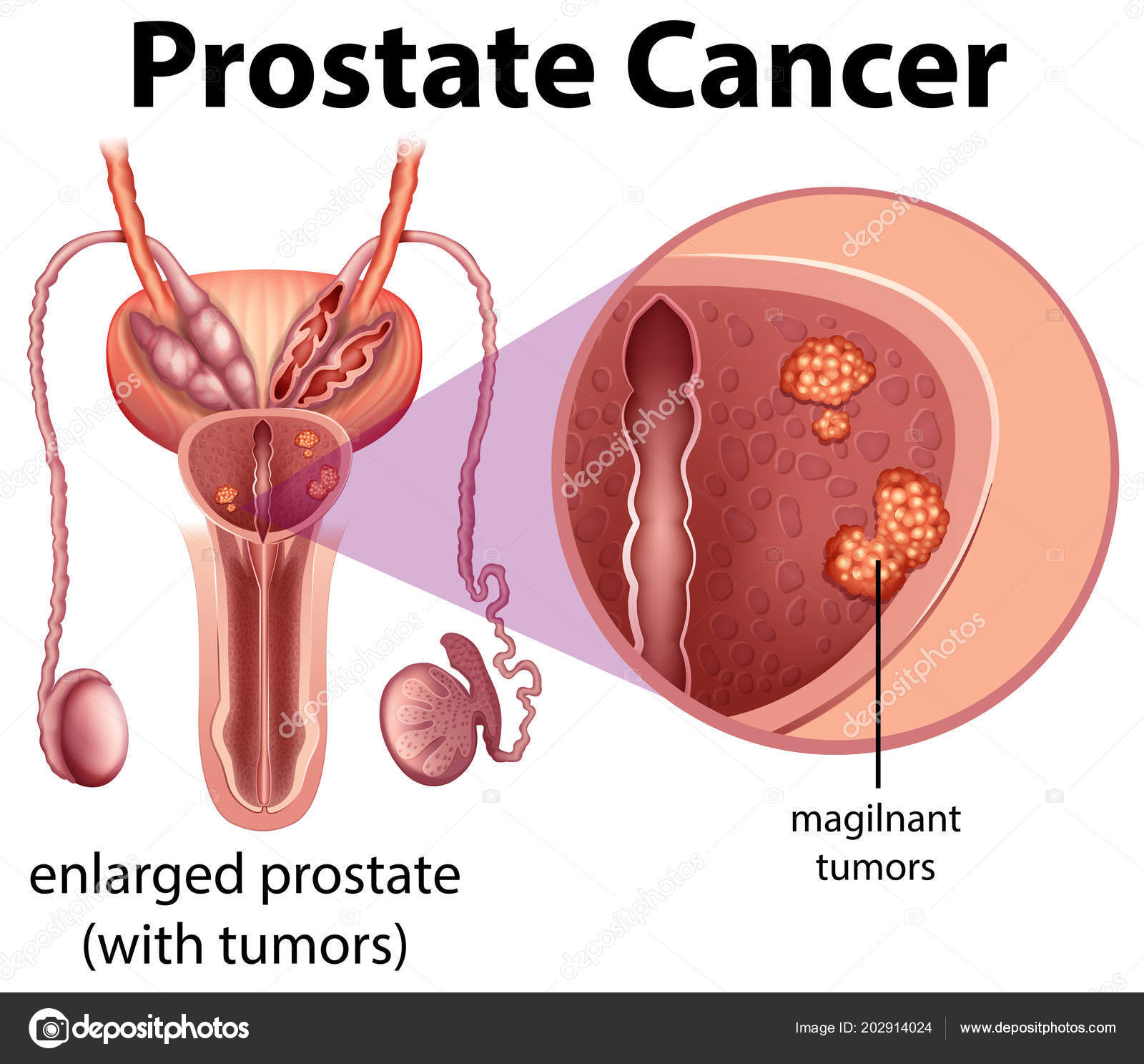 prostatitis recurrente tratamiento A krónikus prosztatitis 20 év alatt