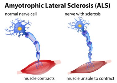 Amyotrophic lateral sclerosis concept illustration clipart