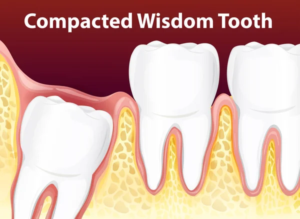 Illustrazione Compatta Del Diagramma Del Dente Della Saggezza — Vettoriale Stock