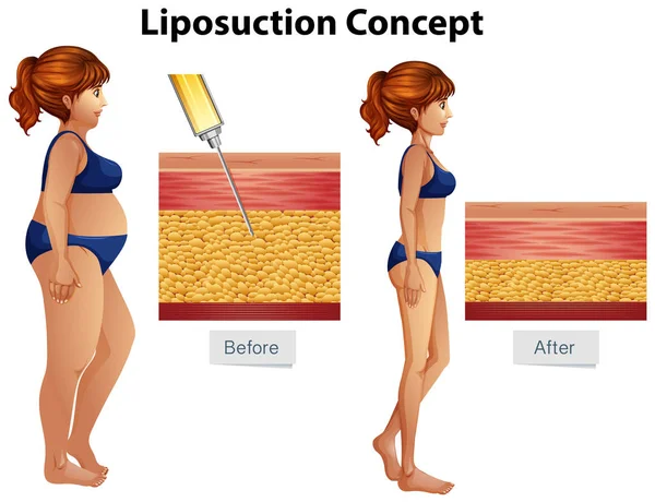 Człowiek Ilustracja Koncepcja Liposukcja Diagramu — Wektor stockowy