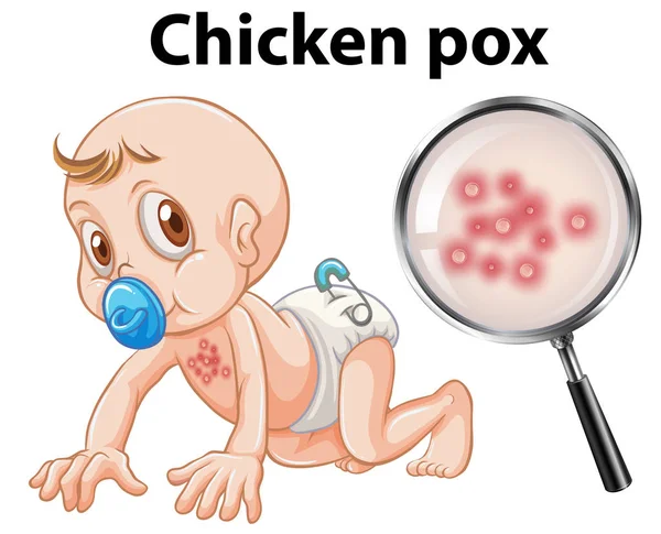Baby Chicken Pox Illustration — Stock Vector