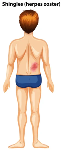 Hombre Con Herpes Zóster Espalda Ilustración — Vector de stock