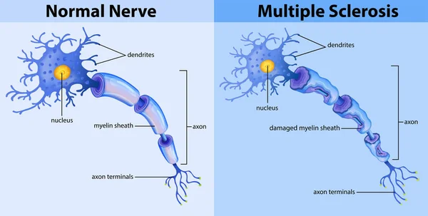 Nervio Normal Esclerosis Múltiple Ilustración — Vector de stock