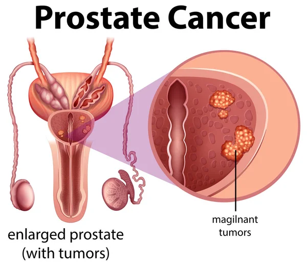 krónikus prostatitis vezikulit pion evad és prostatitis
