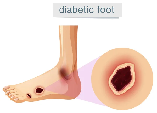 Piede Diabetico Ingrandito Piedi Illustrazione — Vettoriale Stock