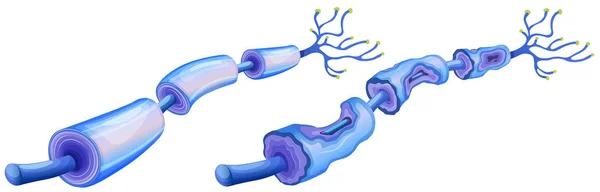 Mänskliga Nerver Cell Och Perifer Neuropati Illustration — Stock vektor
