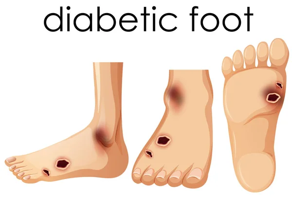 人的脚与糖尿病例证 — 图库矢量图片