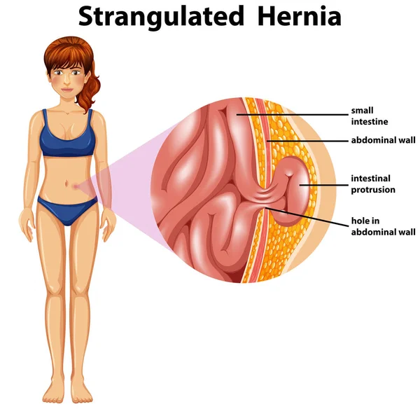 Donna Strangolata Ernia Illustrazione Diagramma — Vettoriale Stock