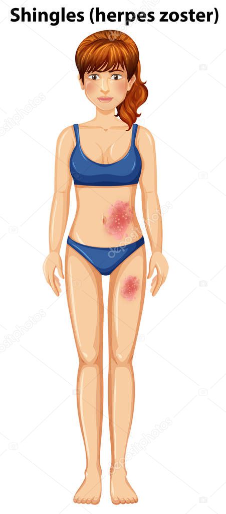 A Woman Have Shingles on Skin illustration