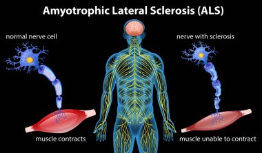 Anatomy of amyotrophic lateral sclerosis illustration clipart