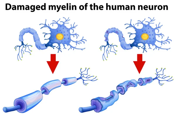 Dammaged Myelin Human Neuron Illustration — Stock Vector