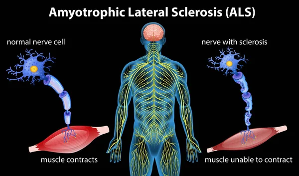 Anatomy Amyotrophic Lateral Sclerosis Illustration — Stock Vector