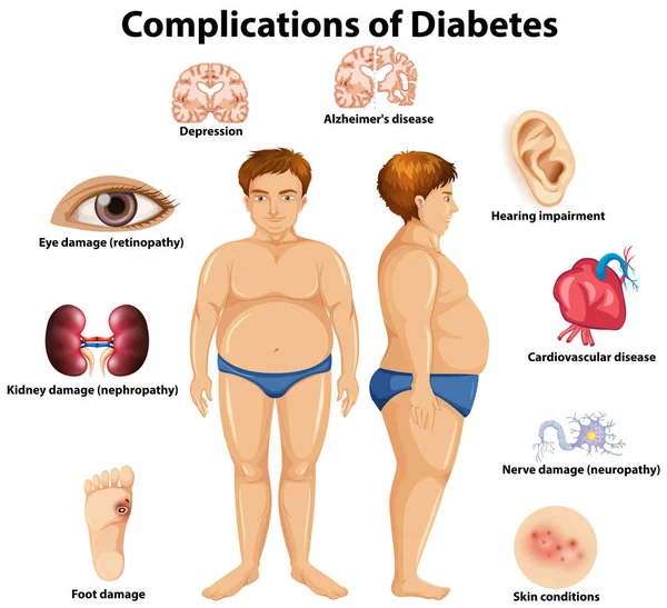 Complications Diabetes Concept Illustration — Stock Vector