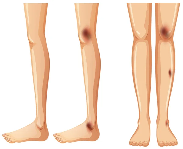 Side Front Bruises Leg Illustration — Stock Vector