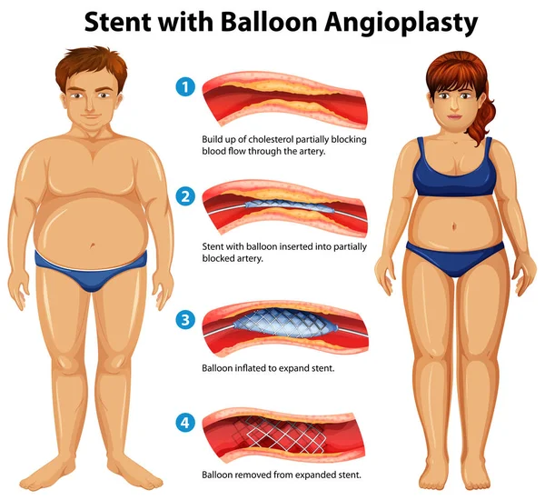 Stent Con Ilustración Angioplastia Con Balón — Vector de stock
