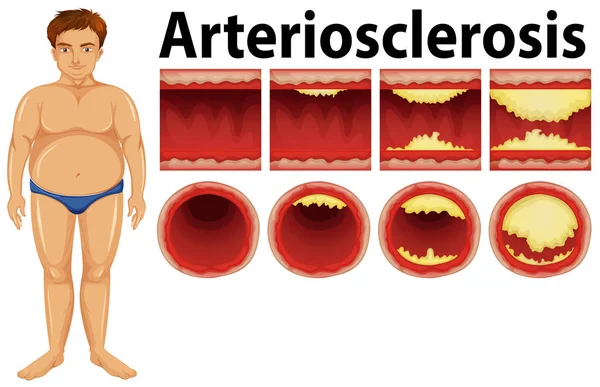 Fat Man Atherosclerosis Illustration — Stock Vector