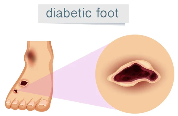 Piede Umano Con Illustrazione Diabetica — Vettoriale Stock