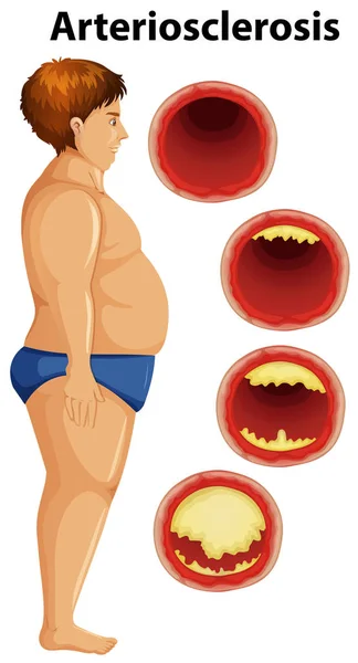 Tlustý Muž Arterioskleróza Ilustrace — Stockový vektor