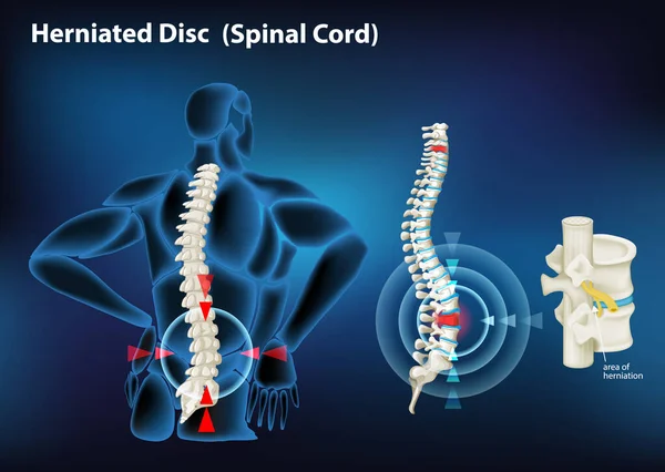 Diagrama que muestra hernia discal en humanos — Archivo Imágenes Vectoriales