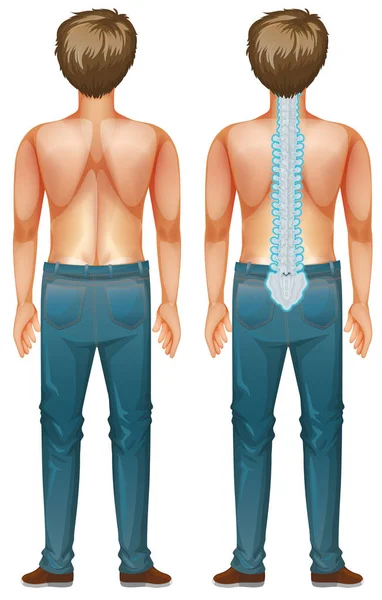 Человек с повреждением спинного мозга — стоковый вектор