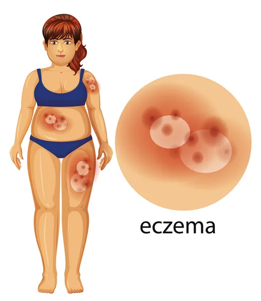 Diagram showing woman with eczema — Stock Vector