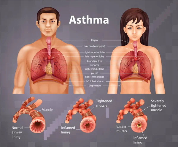 Comparação Pulmão Saudável Ilustração Pulmão Asmático — Vetor de Stock