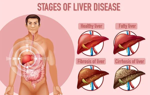 Stages Liver Disease Illustration — Stock Vector