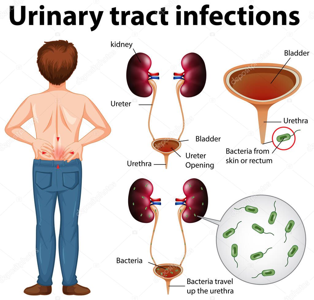 Informative illustration of urinary tract infections illustration