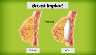 İnsan göğüs implantı örnekleme anatomisi
