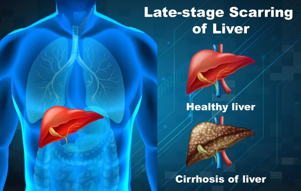 Późne Stadium Bliznowacenia Wątroby Ilustracji — Wektor stockowy