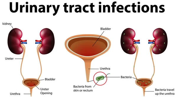 Ilustración Informativa Infecciones Del Tracto Urinario Ilustración — Archivo Imágenes Vectoriales