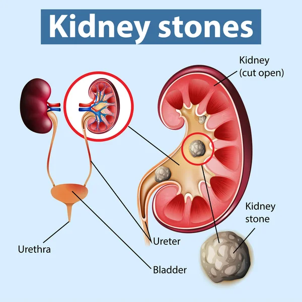 Informative Illustration Kidney Stones Illustration — Stock Vector