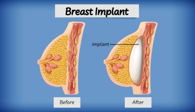İnsan göğüs implantı örnekleme anatomisi