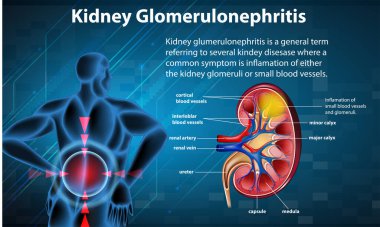Böbrek glomeruloskleroz illüstrasyonunun tıbbi bilgileri