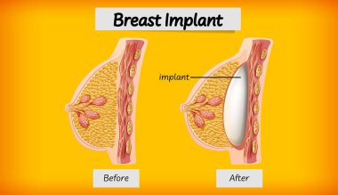 İnsan göğüs implantı örnekleme anatomisi