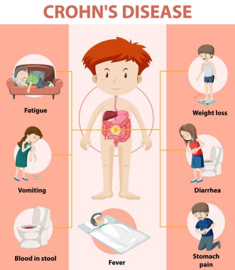 Crohn 'un Hastalık İllüstrasyonunun Tıbbi Bilgileri