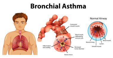 Astım iltihaplı bronş tüpü çizimi