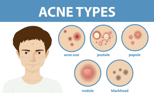 Types of acne on the skin or pimples illustration