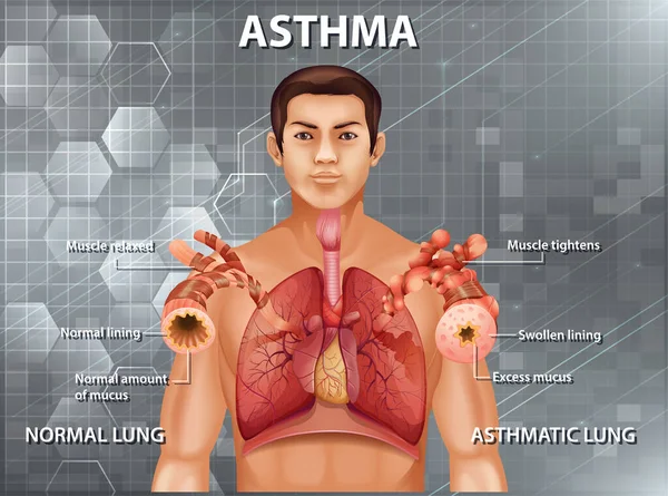 Comparação Pulmão Saudável Ilustração Pulmão Asmático — Vetor de Stock