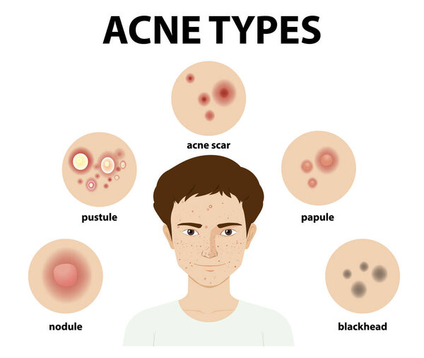 Types of acne on the skin or pimples illustration