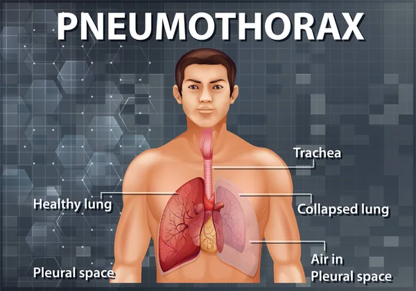 Ilustração Informativa Ilustração Pneumotórax — Vetor de Stock