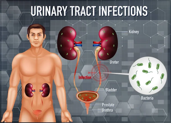Ilustração Informativa Infecções Trato Urinário Ilustração —  Vetores de Stock